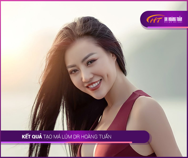 Kết quả tạo má lúm Thẩm mỹ Hoàng Tuấn